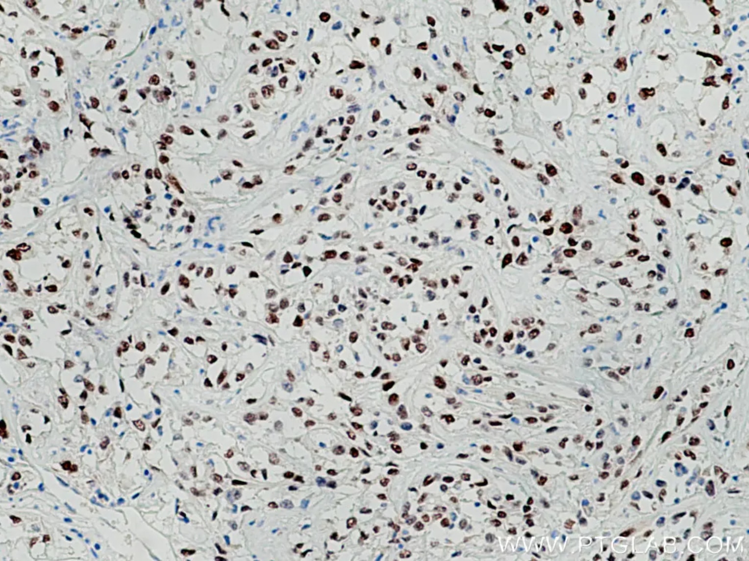 PAX8抗体を使用したパラフィン包埋ヒト腎細胞癌組織スライドの免疫組織化学染色。