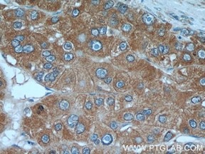 α-フェトプロテイン抗体を用いたパラフィン包埋ヒト肝臓がんの免疫組織化学染色