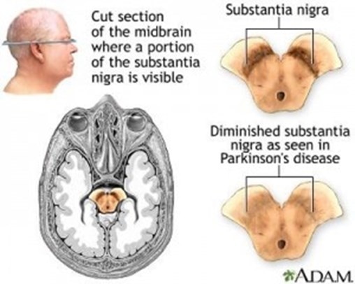 人の頭部の断面図および健常人とパーキンソン病患者の黒質緻密部のイラスト（パーキンソン病患者の中脳の黒質緻密部のドーパニューロン細胞数は健常人よりも減少する）