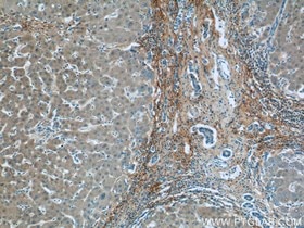 Collagen III抗体を用いたパラフィン包埋ヒト肝硬変組織の免疫組織化学染色