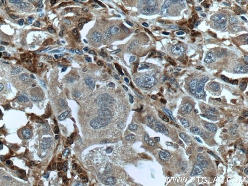 第XIIIa因子抗体を使用したパラフィン包埋ヒト肝臓がん組織スライドの免疫組織化学染色