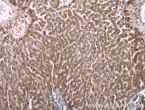 第Ⅱ因子抗体を使用したパラフィン包埋ヒト肝臓がん組織スライドの免疫組織化学染色