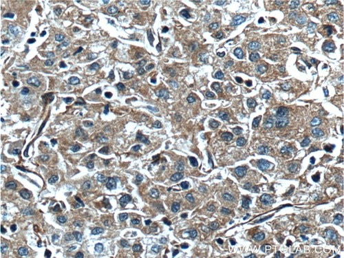 第Ⅴ因子抗体を使用したパラフィン包埋ヒト肝臓がん組織スライドの免疫組織化学染色