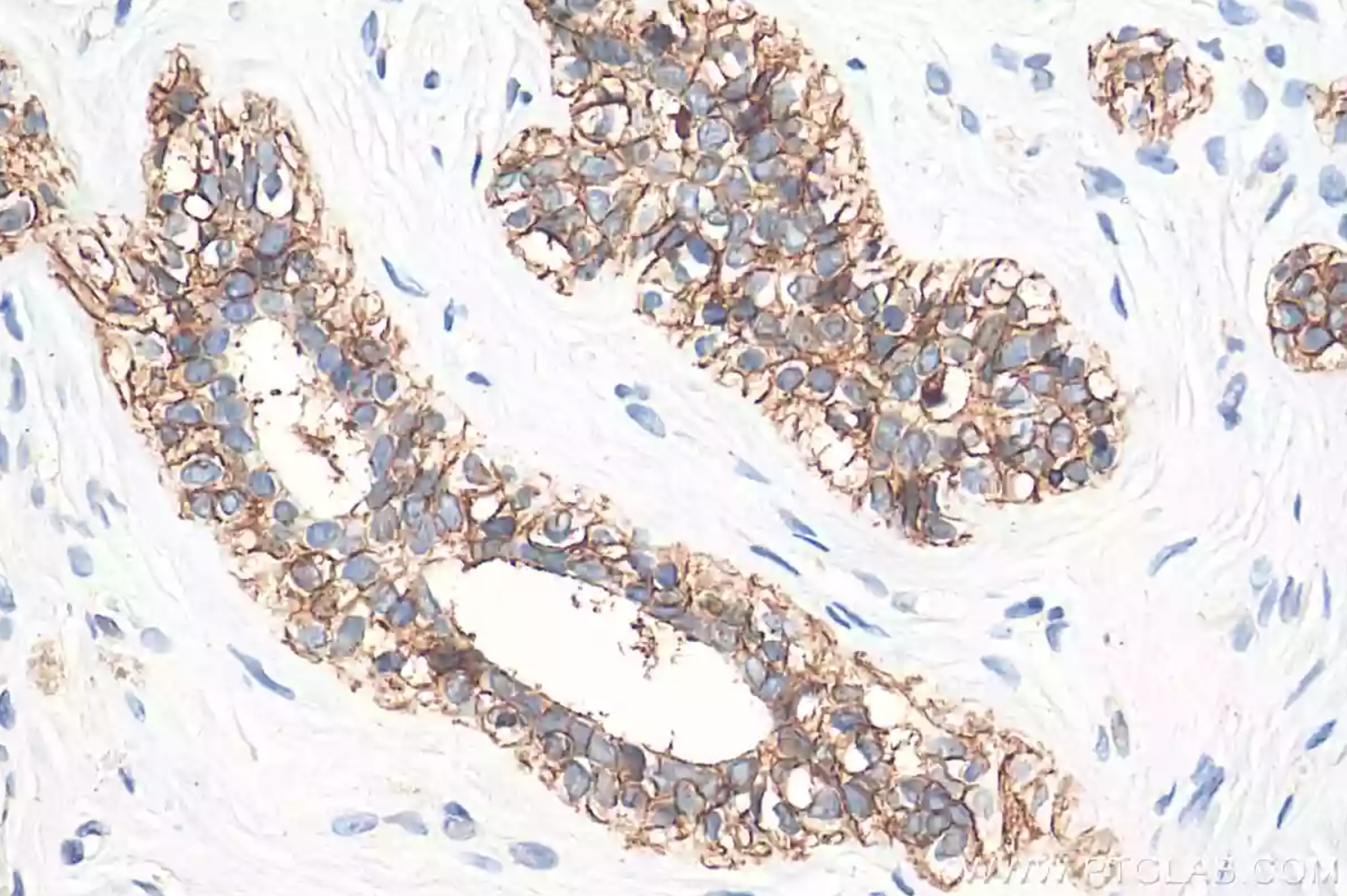 E-カドヘリン抗体を使用したパラフィン包埋ヒト乳がん組織スライドの免疫組織化学染色。