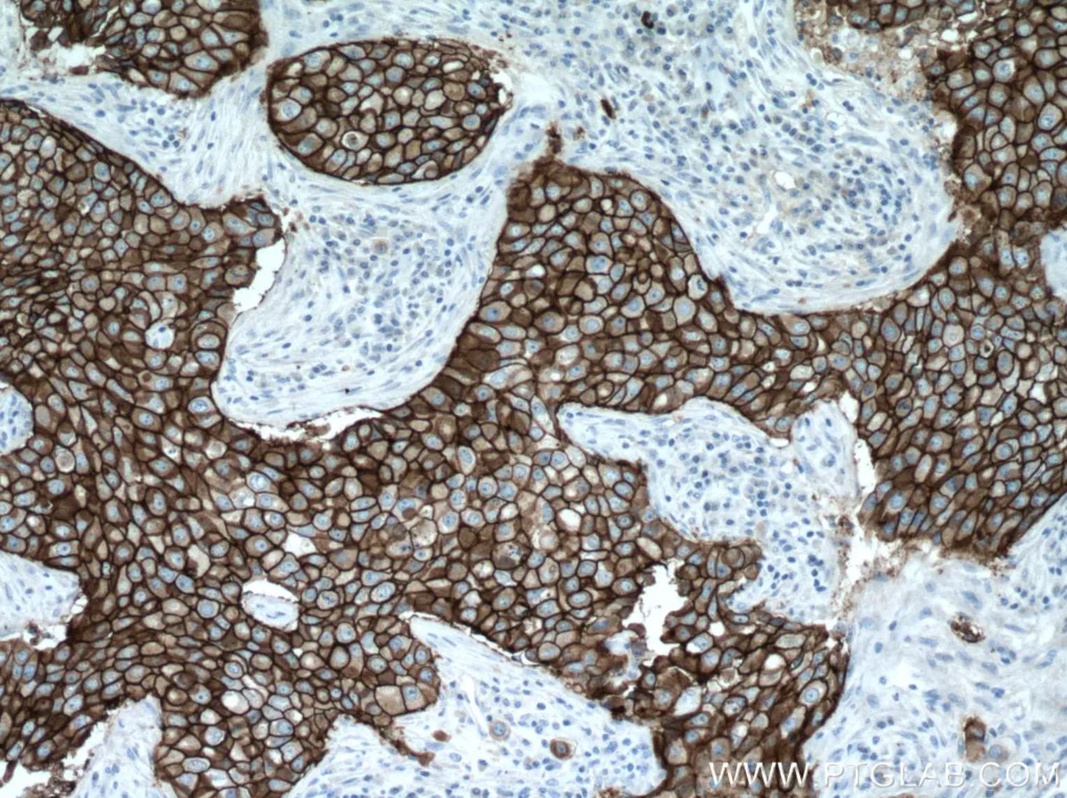 HER2/ErbB2抗体を使用したパラフィン包埋ヒト乳がん組織スライドの免疫組織化学染色。