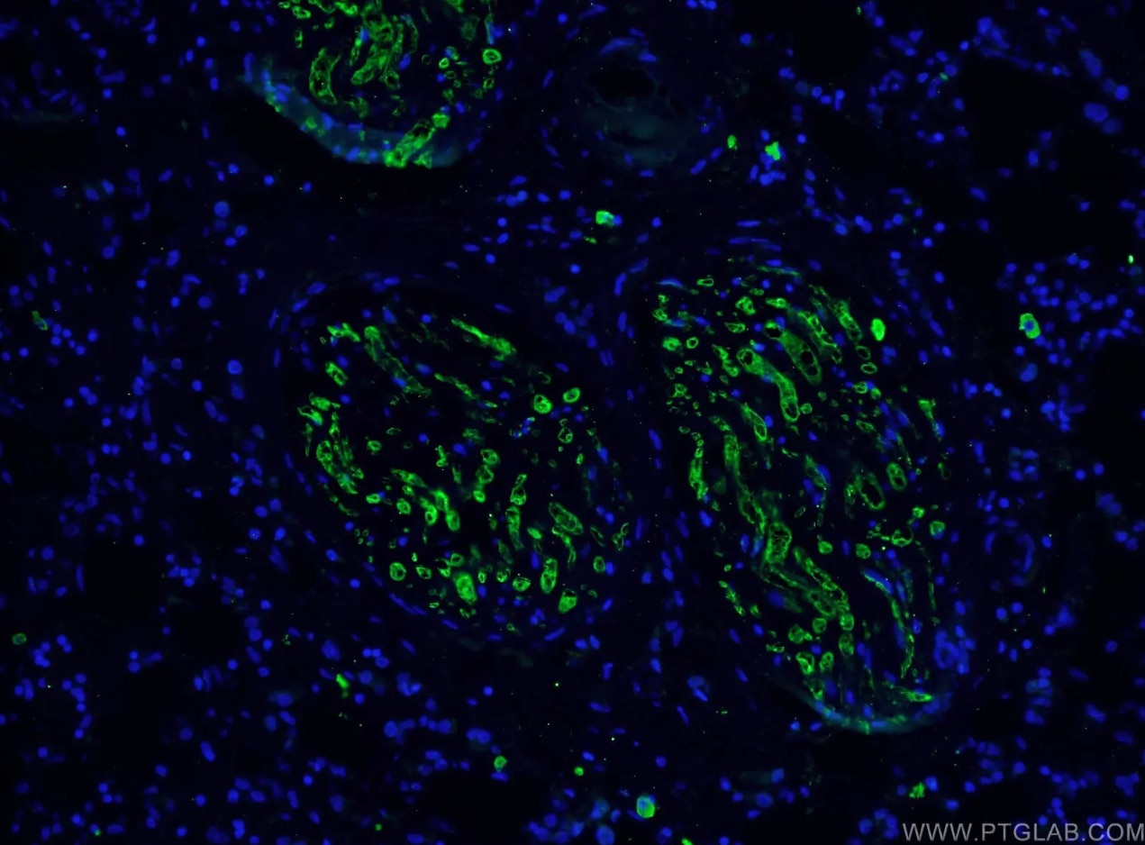 カスパーゼ3抗体およびAlexa Fluor 488-conjugated AffiniPure Goat Anti-Mouse IgGを用いたヒト乳がん組織の免疫蛍光染色