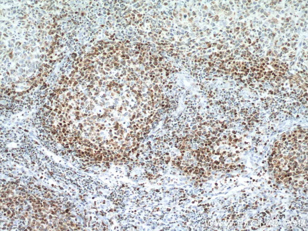 Bcl2抗体を用いたヒトリンパ腫組織の免疫組織化学染色