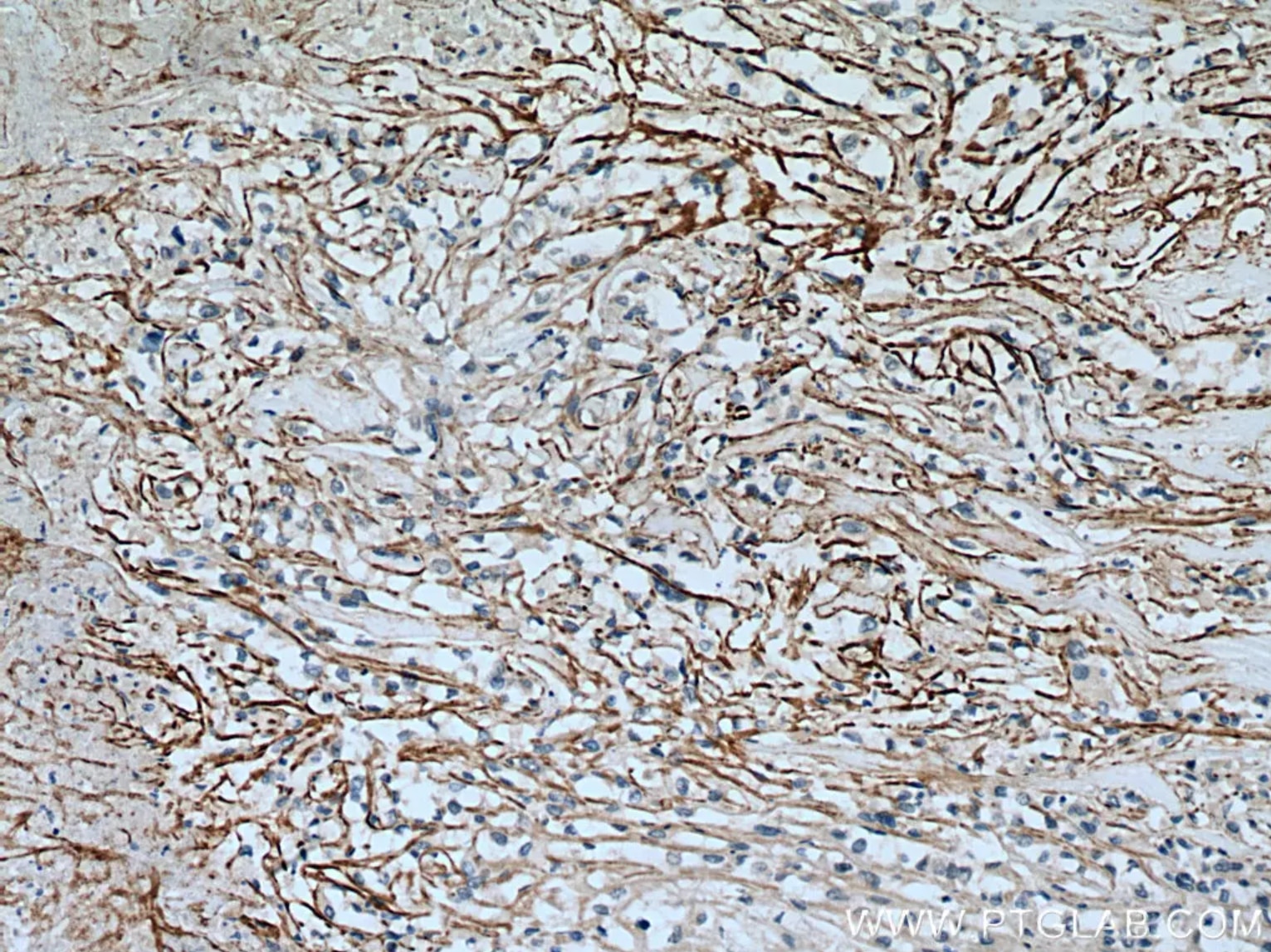 SLC7A11/xCT抗体を使用したヒト腎臓細胞癌の免疫組織化学染色