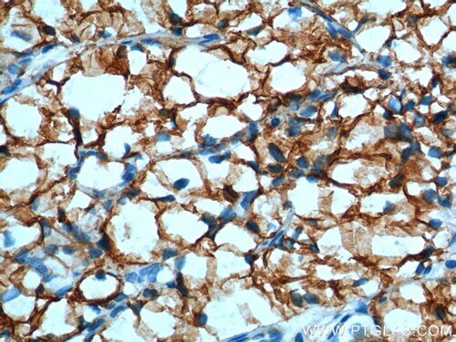 CA9抗体を使用したパラフィン包埋ヒト腎細胞癌組織スライドの免疫組織化学。