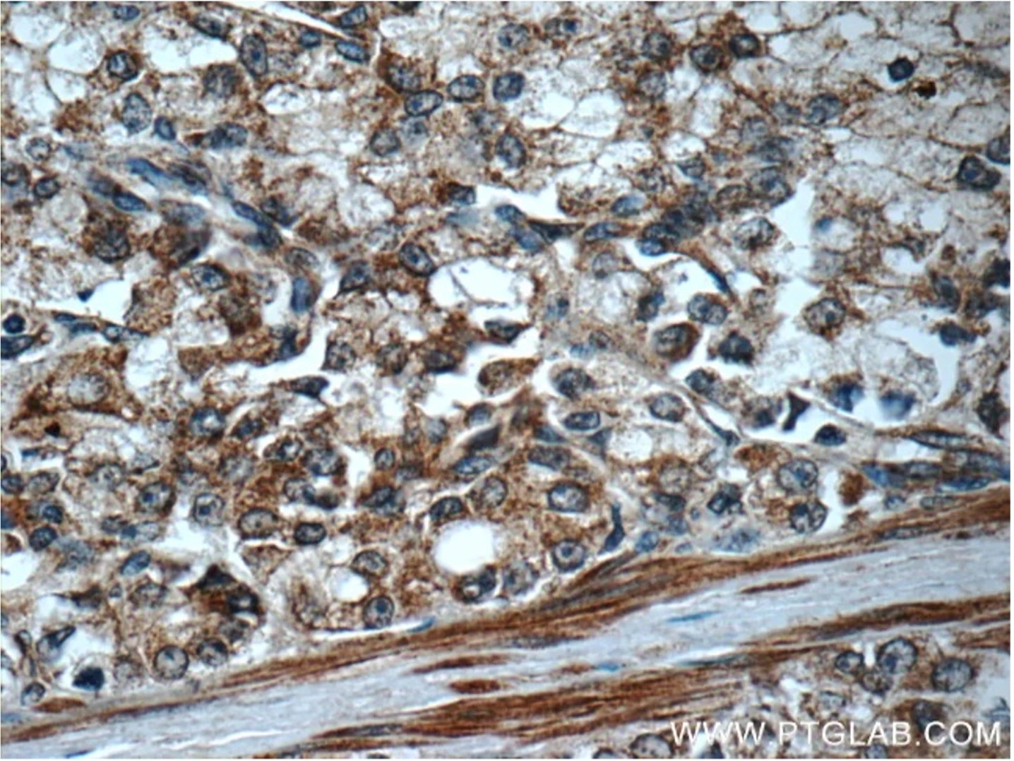 FAS抗体を使用したパラフィン包埋ヒト前立腺がん組織の免疫組織化学染色