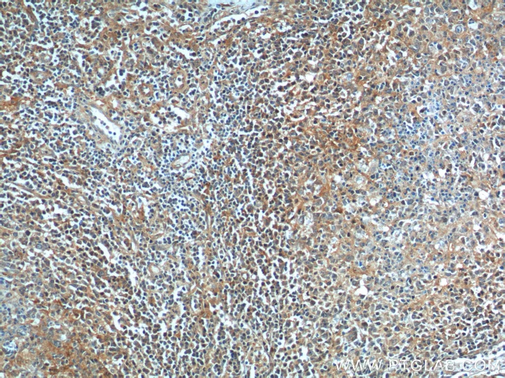 BAD抗体を使用したパラフィン包埋ヒト悪性リンパ腫組織スライドの免疫組織化学染色
